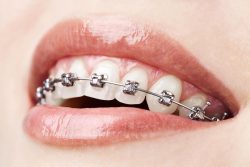 How To Find Orthodontic Treatment In Aventura, Fl?