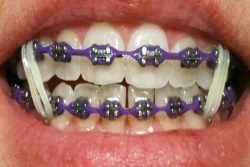 How To Find Orthodontic Treatment In Aventura, Fl?