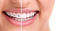 Dental Braces In Aventura Fl
