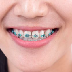 How To Find The Best Orthodontics In Aventura, Fl?