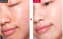 Improve The Quality Of Skin With Mesotherapy