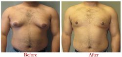 Best Gynecomastia Surgery in Delhi | Sculpt India