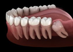 How Long Does It Take For Wisdom Teeth To Heal?