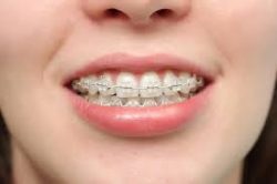 Finding the Best Orthodontist for Braces Near me in Miami Shores