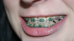 Finding Great Pediatric Orthodontist in Miami Means Great Smiles for Life