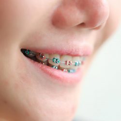 Best Orthodontist for Braces Near Me on a Budget | Ivanov Orthodontic