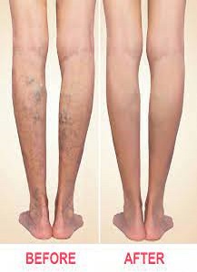 Varicose are Veins Treatment in the Near Me