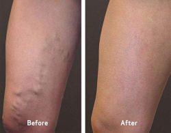 Vein Treatment are Clinic in the Near Me