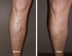 Spider Vein Treatment Near Me