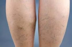 Varicose Vein Treatment Near Me