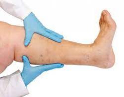 Varicose veins – Symptoms and causes 