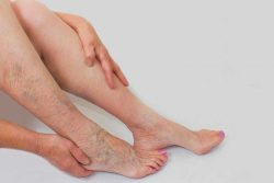 Venous Insufficiency: Injection Sclerotherapy