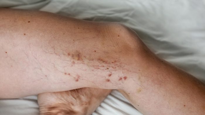 What happens if you don’t seek varicose vein treatment?