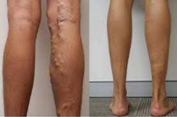 Is sclerotherapy for varicose veins painful?