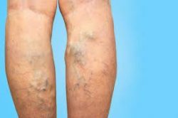 Avoid vein doctors and vein centers that recommend vascular surgery.