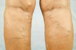 Go through the state-of-the-art vein centers’ varicose vein treatment options.