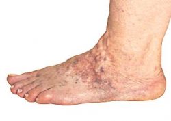 The Minimally Invasive Varicose Vein Treatments