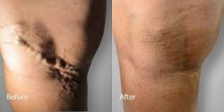 Vein Treatment near Me NYC