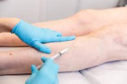 Vein Clinic Midtown that Offers Minimally-Invasive Treatments