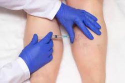 Find the Best Vein Doctor in Texas