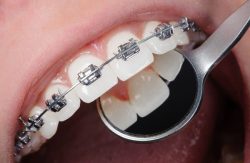 INVISALIGN ALIGNERS AND RETAINERS FOR STRAIGHT TEETH