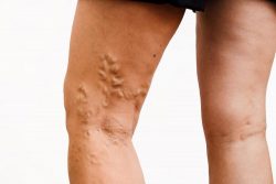 Cosmetic Vein Treatment