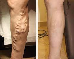 Vein treatment must be done only by trained phlebologists