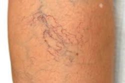 What are the Best Treatment Options for Varicose Veins?