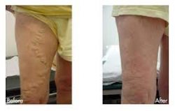 Vein Treatment Clinic is the best varicose vein center in LI.