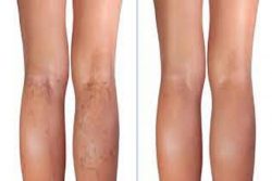 How can I find the right varicose vein center in Texas?