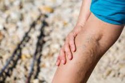 What happens if I don’t seek varicose vein treatments promptly?