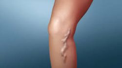 The Best Minimally Invasive Varicose Vein Treatments