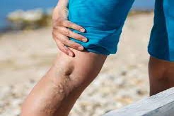 Your vein specialist may be able to diagnose restless legs syndrome