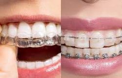 Invisalign Orthodontist Near Sunny Isles Beach, Fl
