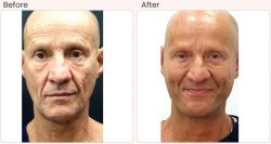 Facelift Surgery in Delhi