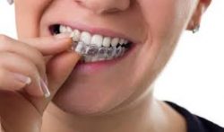 How to Fix a Misaligned Jaw – Jaw Alignment Braces Treatment Options?