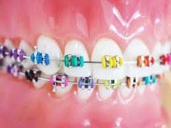 Which Is Best For You: Ceramic Braces or Metal Braces?