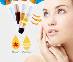 PRP Treatment in South London | EpicDermis