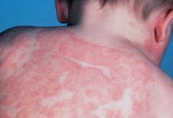 Eczema Treatment in Delhi