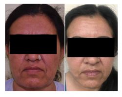 Best Facelift Surgery in Delhi | Dr. Vivek Kumar