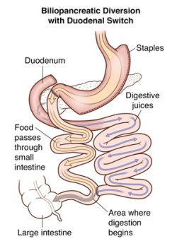 hernia surgery