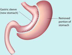 gastric sleeve dubbo