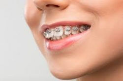 How Much Do Braces Cost for Children? | IVANOV Orthodontic Experts