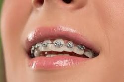 Orthodontist Near Me Which Invisalign Miami & Invisible Braces To Choose