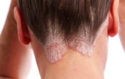 Psoriasis Cure in Delhi