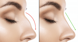 Rhinoplasty surgeon in Delhi