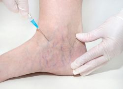 What Causes Spider Veins?