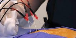 What are the Side Effects of Radiofrequency Ablation?