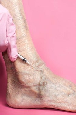 What is Sclerotherapy and How Does it Work?