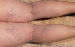 Causes of Spider and Varicose Veins